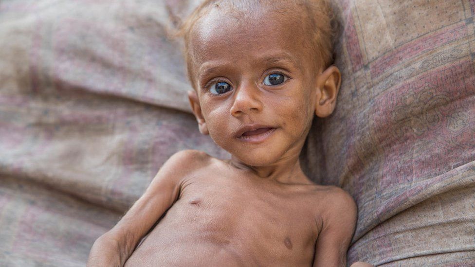 لە یەمەن زیاتر لە 17 ملیۆن کەس بەدەست برسێتییەوە دەناڵێنن
